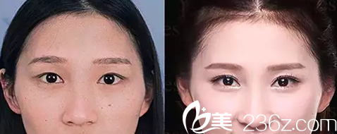 大同美神整形美容醫(yī)院開眼角前后效果對比圖