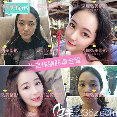 深圳弘美醫(yī)療美容整形醫(yī)院陳國兵自體脂肪全臉填充案例