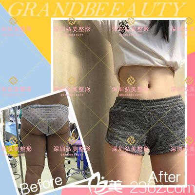 深圳弘美醫(yī)療美容整形醫(yī)院陳國兵腰腹部吸脂案例圖