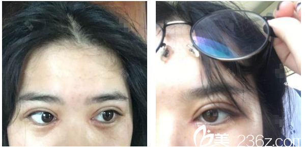 深圳弘美醫(yī)療美容整形醫(yī)院陳國(guó)兵院長(zhǎng)雙眼皮術(shù)后天圖片