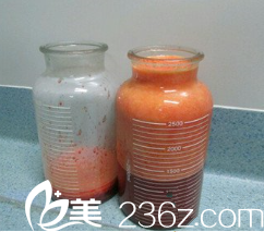 抽出來的脂肪挺惡心的