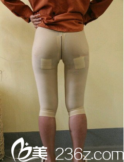 張寶譽大腿吸脂術(shù)后14天