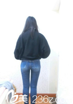 新疆伊麗莎白整形大腿吸脂術(shù)后一個月