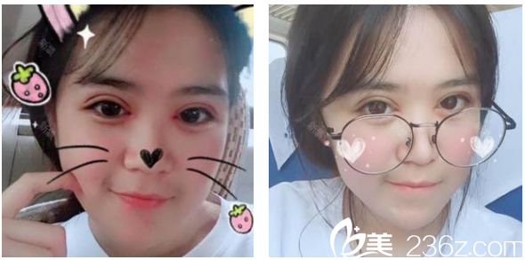 深圳弘美醫(yī)療美容整形醫(yī)院陳國(guó)兵院長(zhǎng)雙眼皮術(shù)后八天拆線效果圖