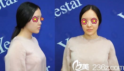 到杭州瑞麗做隆鼻前