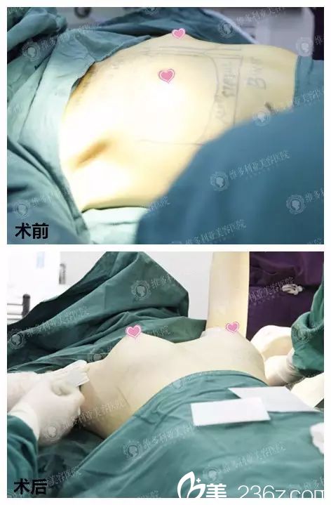 隆胸術(shù)前術(shù)后即刻對比照片 隆胸術(shù)前術(shù)后即刻對比照片