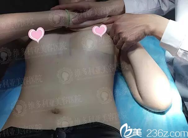 南京維多利亞隆胸哪個醫(yī)生好?糾結(jié)劉光偉和李志生后做了美國艾爾建娜琦麗毛面水滴假體來看效果怎么樣