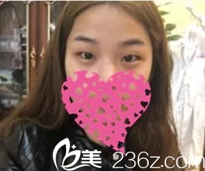 術前是腫泡眼 術前是腫泡眼