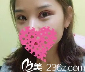 剛做完手術雙眼皮微腫 剛做完手術雙眼皮微腫