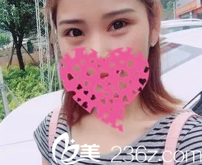 恢復18天的雙眼皮腫脹全消 恢復18天的雙眼皮腫脹全消