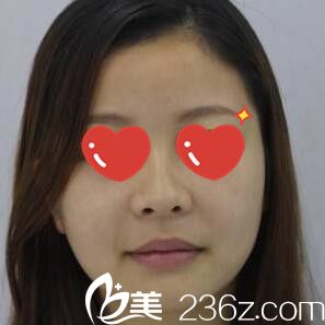 自體脂肪填充面部術(shù)前 自體脂肪填充面部術(shù)前