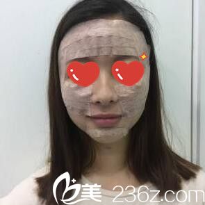 面部脂肪填充第三天 面部脂肪填充第三天