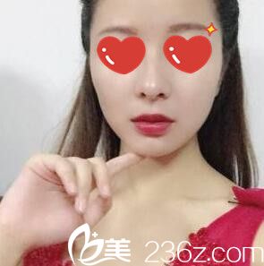 沒想到我找長沙科顏美整形美容做自體脂肪填充面部效果變化這么大 美膩了！