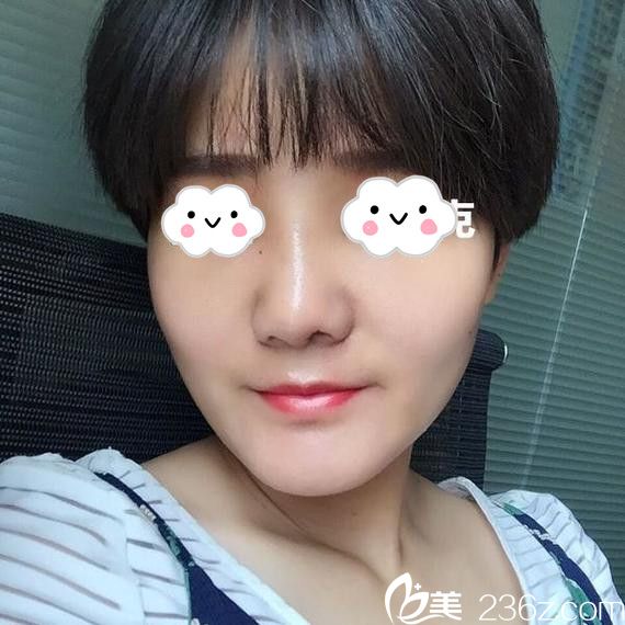 淮北微悅硅膠假體隆鼻真人案例