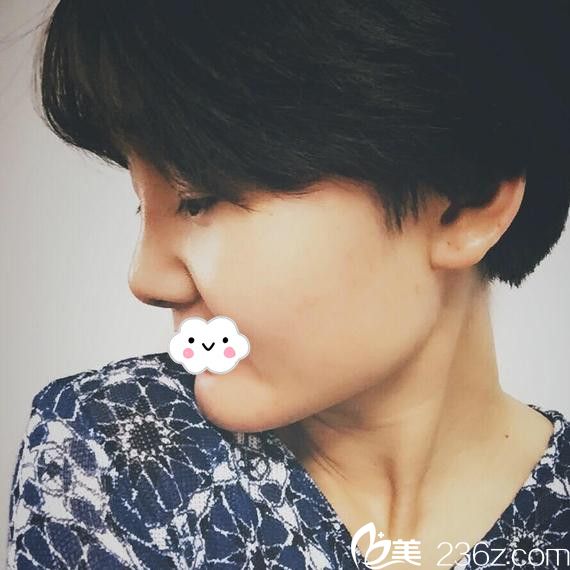 淮北微悅假體隆鼻術(shù)后恢復(fù)效果