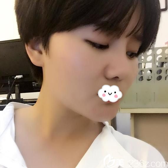 看我鼻整形真人案例就知道淮北微悅硅膠假體隆鼻效果怎么樣了