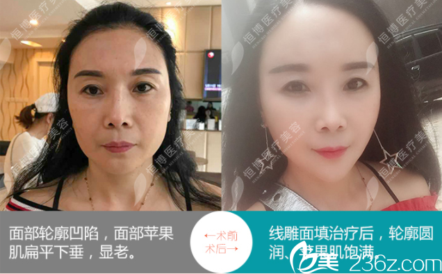 成都恒博線雕面填充治療案例