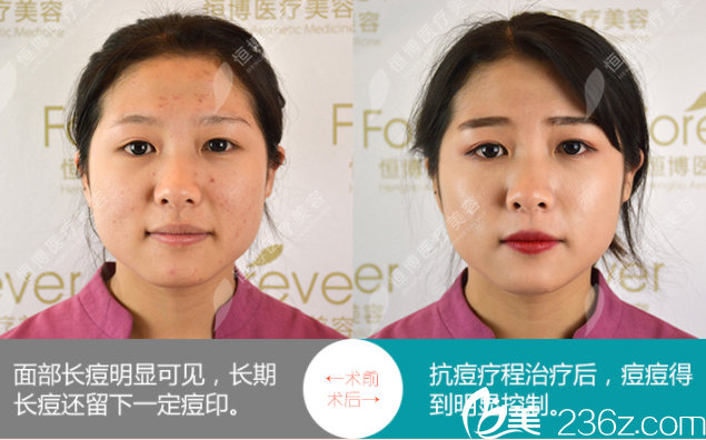 成都恒博去除痘痘
