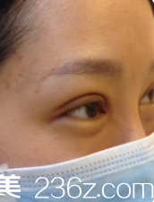 剛做完雙眼皮眼睛腫脹