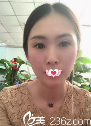 雙眼皮恢復(fù)16天完全消腫