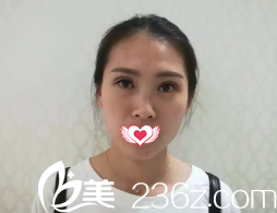 恢復(fù)7天后雙眼皮拆線后的樣子