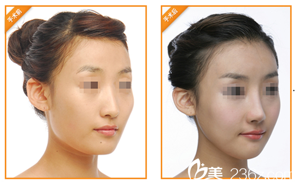 韓國麗兒整形醫(yī)院顴骨內(nèi)推+鼻綜合案例