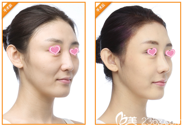 韓國麗兒整形醫(yī)院顴骨內(nèi)推+下頜角手術(shù)