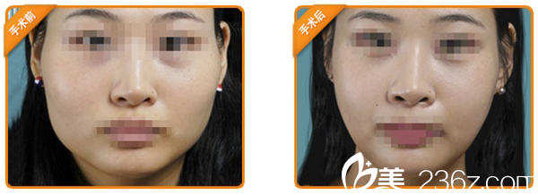 韓國麗兒整形下頜角手術(shù)案例