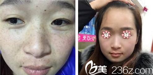 王盛醫(yī)師激光祛斑案例 王盛醫(yī)師激光祛斑案例