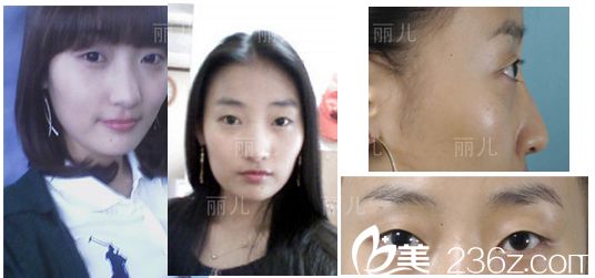 韓國麗兒整形隆鼻后3天