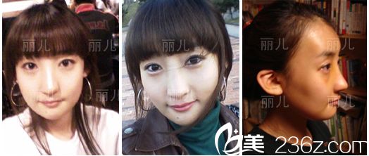 韓國麗兒整形醫(yī)院顴骨縮小案例