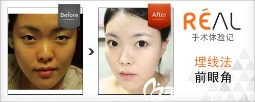 韓國(guó)麗兒整形醫(yī)院埋線雙眼皮手術(shù)真人案例