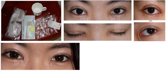 金壽信給我做雙眼皮手術(shù)一周了