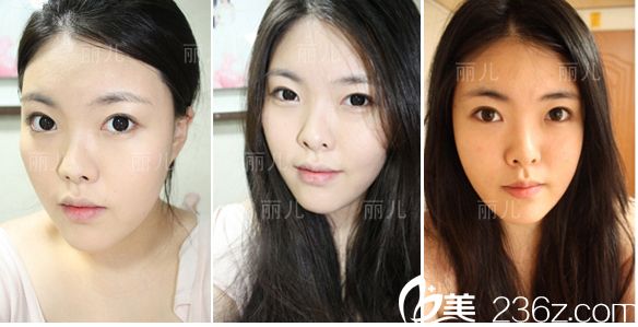 韓國麗兒整形醫(yī)院做雙眼皮怎么樣？分享下金壽信做埋線雙眼皮手術(shù)真人案例