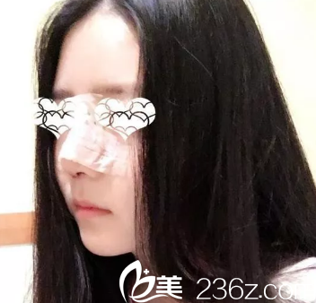 鼻綜合手術(shù)2天鼻子腫脹 鼻綜合手術(shù)2天鼻子腫脹