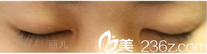 雙眼皮手術(shù)回復(fù)后閉眼效果