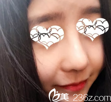 7天拆線后鼻子恢復(fù)情況 7天拆線后鼻子恢復(fù)情況