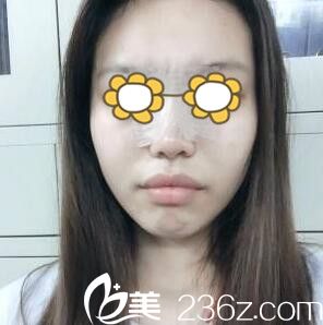 鼻綜合術(shù)后3天