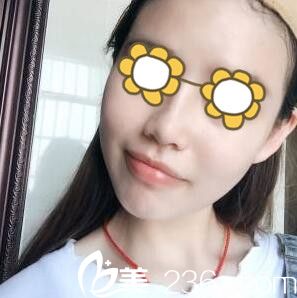 鼻綜合術(shù)后一周拆線