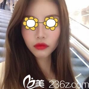 鼻綜合術(shù)后半個(gè)月