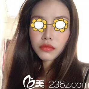 分享我找醫(yī)療美容蔣新力做鼻綜合術(shù)后一個月恢復(fù)效果經(jīng)歷 