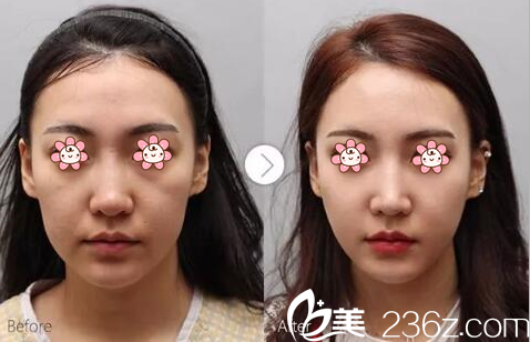 陳波醫(yī)師自體脂肪面部填充案例 陳波醫(yī)師自體脂肪面部填充案例