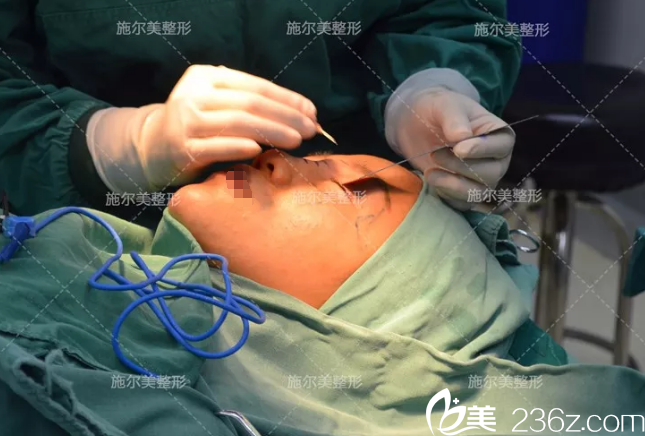 一單一雙做雙眼皮手術(shù)過程中 一單一雙做雙眼皮手術(shù)過程中