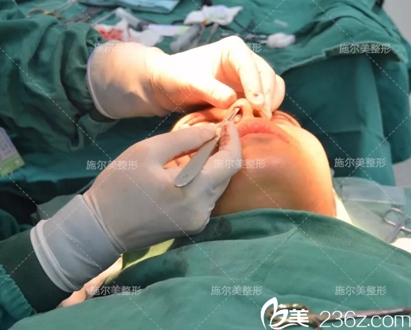 假體隆鼻+縮小鼻翼手術(shù) 假體隆鼻+縮小鼻翼手術(shù)