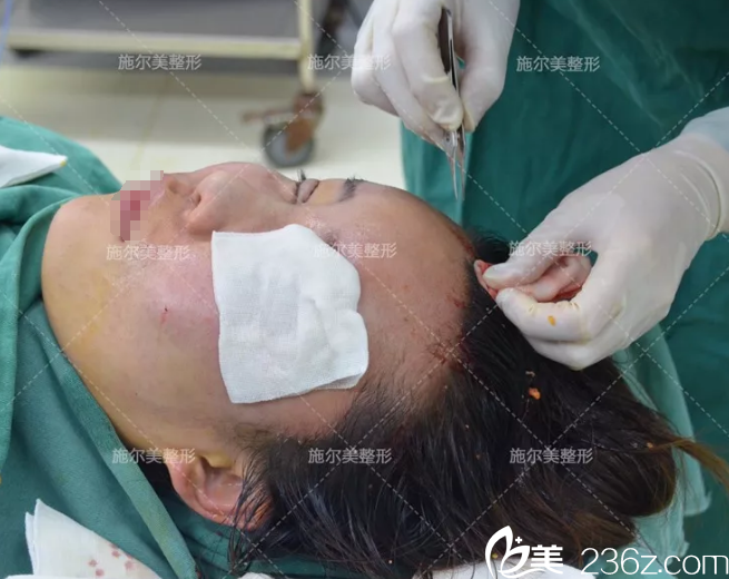 自體脂肪填充額頭過程中 自體脂肪填充額頭過程中