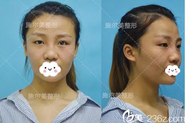 術(shù)前一單一雙眼睛塌鼻子 術(shù)前一單一雙眼睛塌鼻子