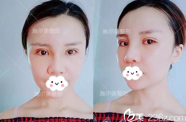 術(shù)后一周雙眼皮拆線鼻子消腫 術(shù)后一周雙眼皮拆線鼻子消腫