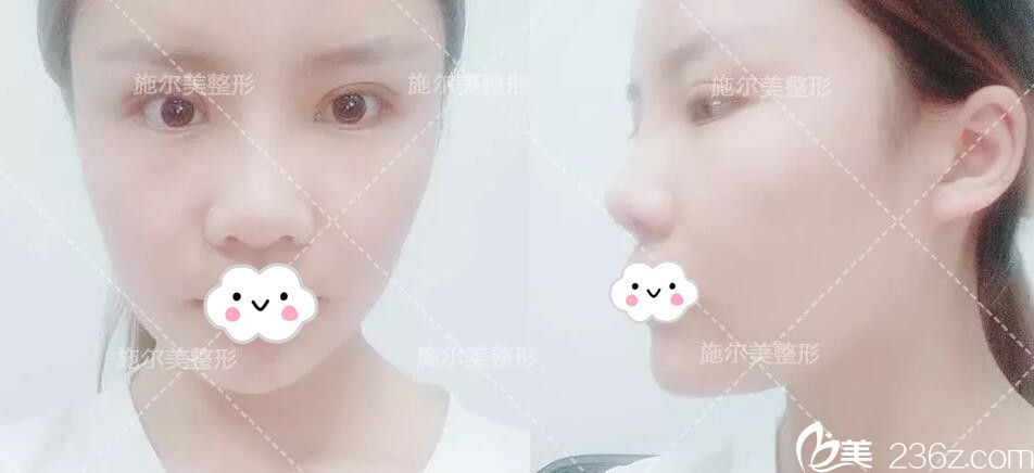 雙眼皮+隆鼻術(shù)后恢復(fù)半個(gè)月 雙眼皮+隆鼻術(shù)后恢復(fù)半個(gè)月