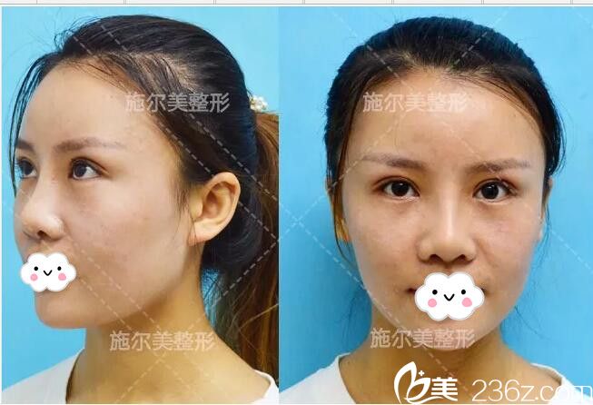 隆鼻+雙眼皮術(shù)后恢復(fù)半個(gè)月 隆鼻+雙眼皮術(shù)后恢復(fù)半個(gè)月