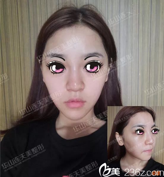 修復(fù)前注射奧美定隆鼻照片 修復(fù)前注射奧美定隆鼻照片